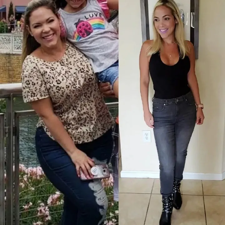 Patient before and after weight loss surgery at Miami VIP Surgery