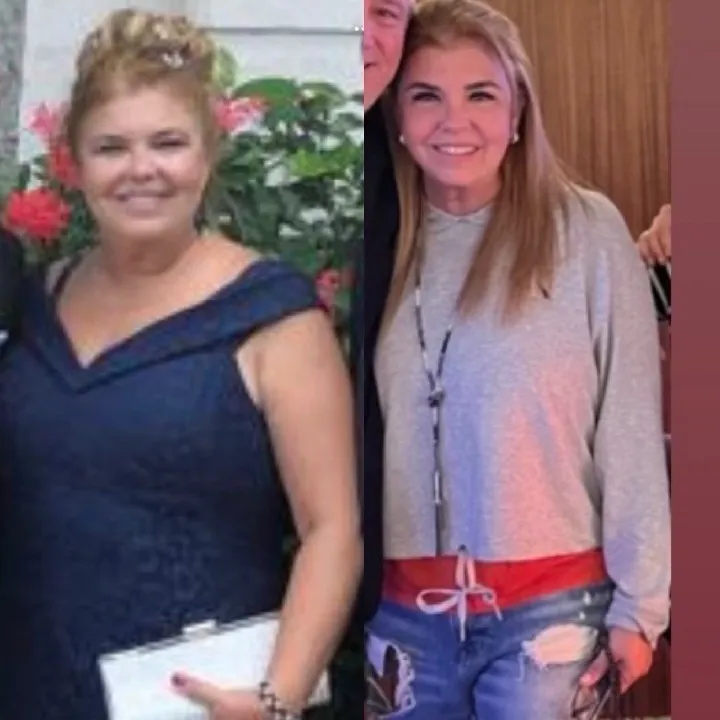 Patient before and after weight loss surgery at Miami VIP Surgery