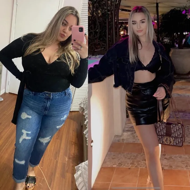 Patient before and after weight loss surgery at Miami VIP Surgery