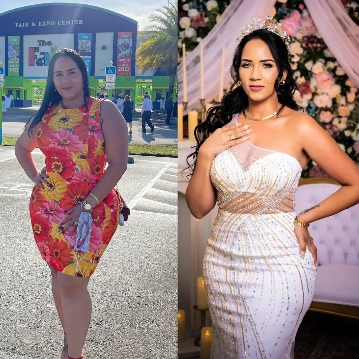 Patient before and after weight loss surgery at Miami VIP Surgery