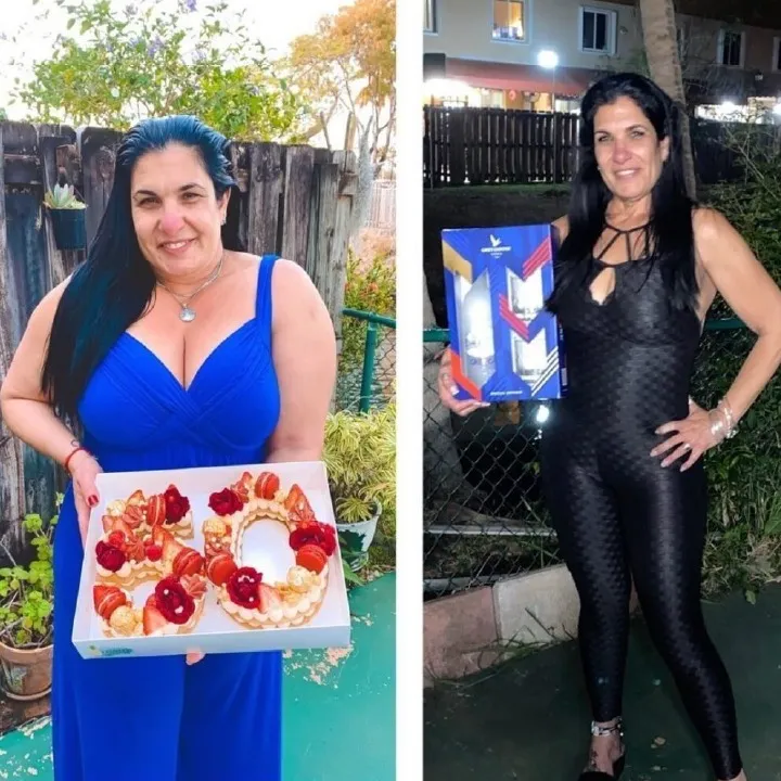 Patient before and after weight loss surgery at Miami VIP Surgery
