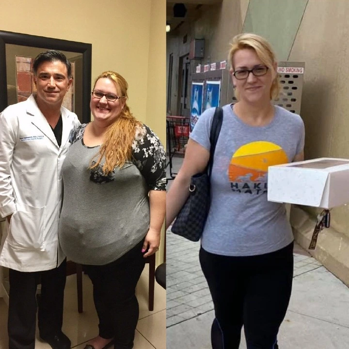 Patient before and after weight loss surgery at Miami VIP Surgery
