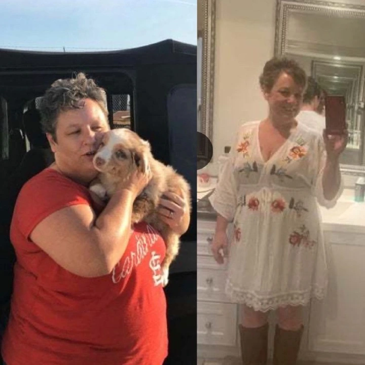 Patient before and after weight loss surgery at Miami VIP Surgery