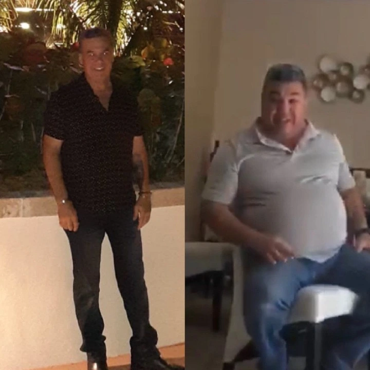 Patient before and after weight loss surgery at Miami VIP Surgery