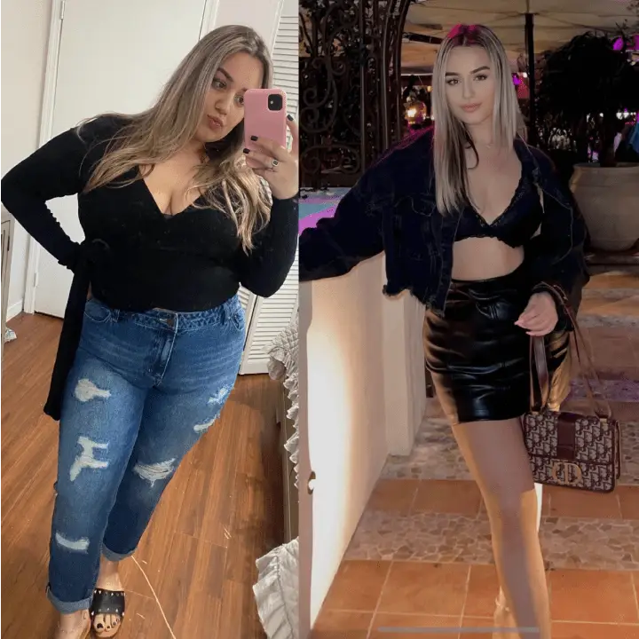 Patient before and after weight loss surgery at Miami VIP Surgery