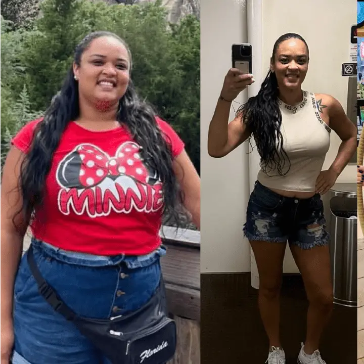 Patient before and after weight loss surgery at Miami VIP Surgery
