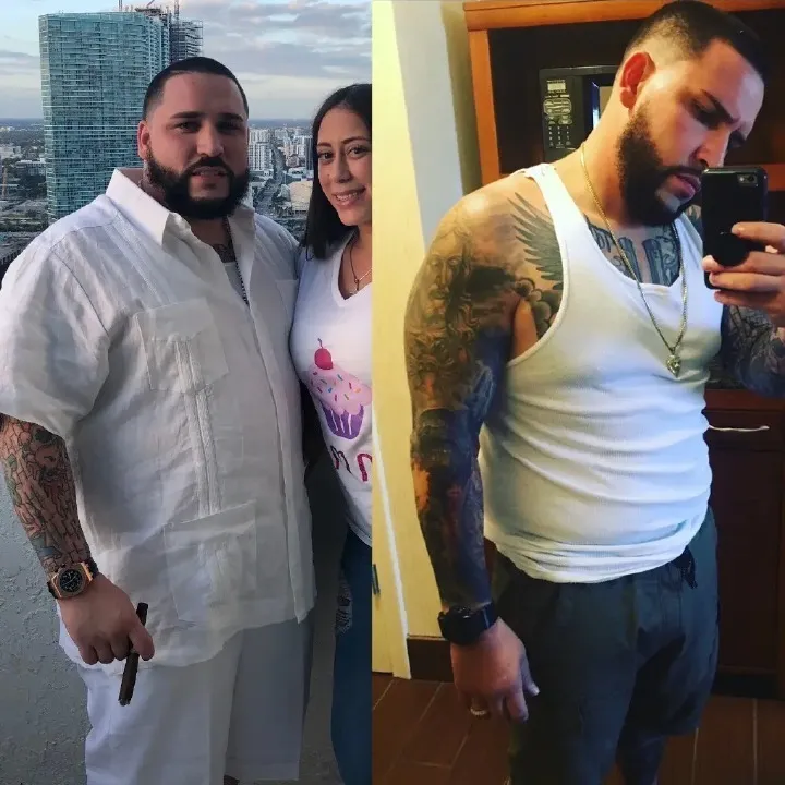 Patient before and after weight loss surgery at Miami VIP Surgery