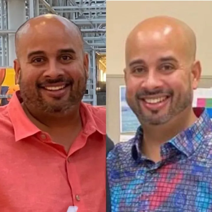 Patient before and after weight loss surgery at Miami VIP Surgery