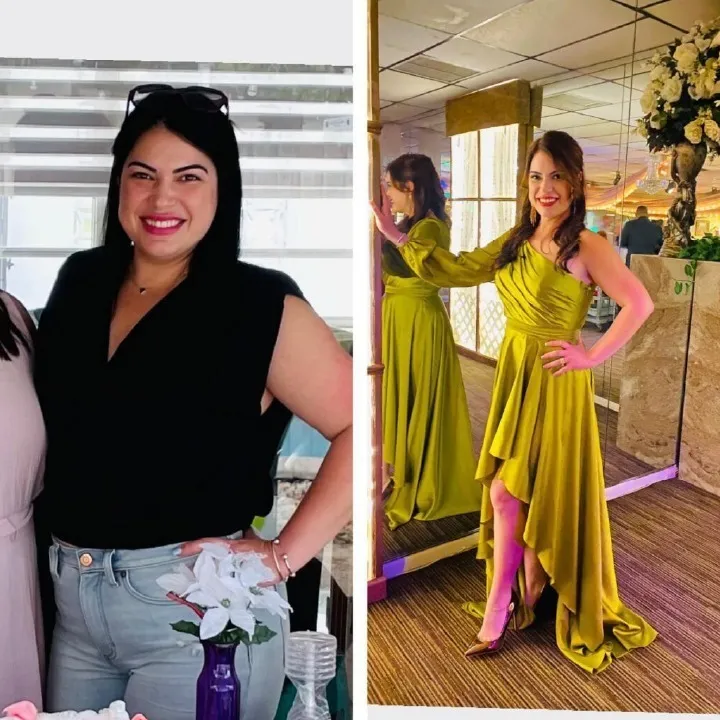 Patient before and after weight loss surgery at Miami VIP Surgery