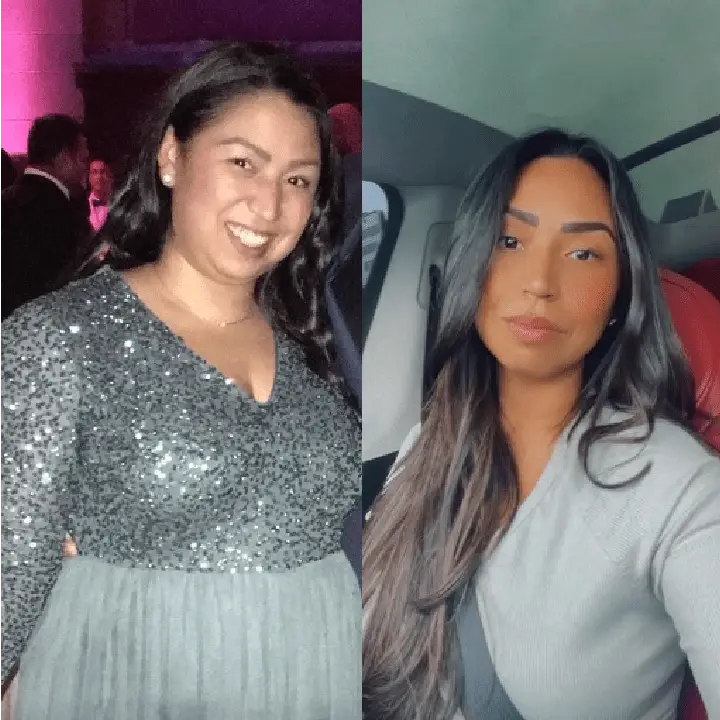 Patient before and after weight loss surgery at Miami VIP Surgery