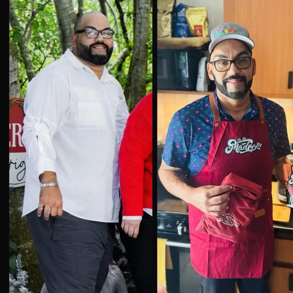 Miami VIP Surgery patient before and after weight loss surgery, transformation 2