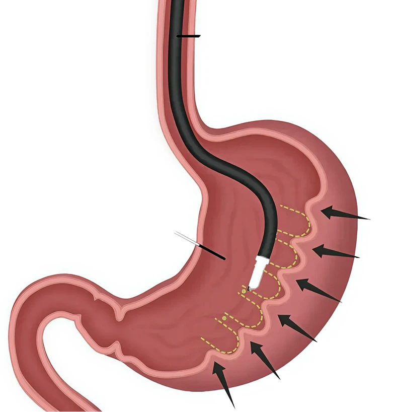 What Is Endoscopic Sleeve Gastroplasty? Banner