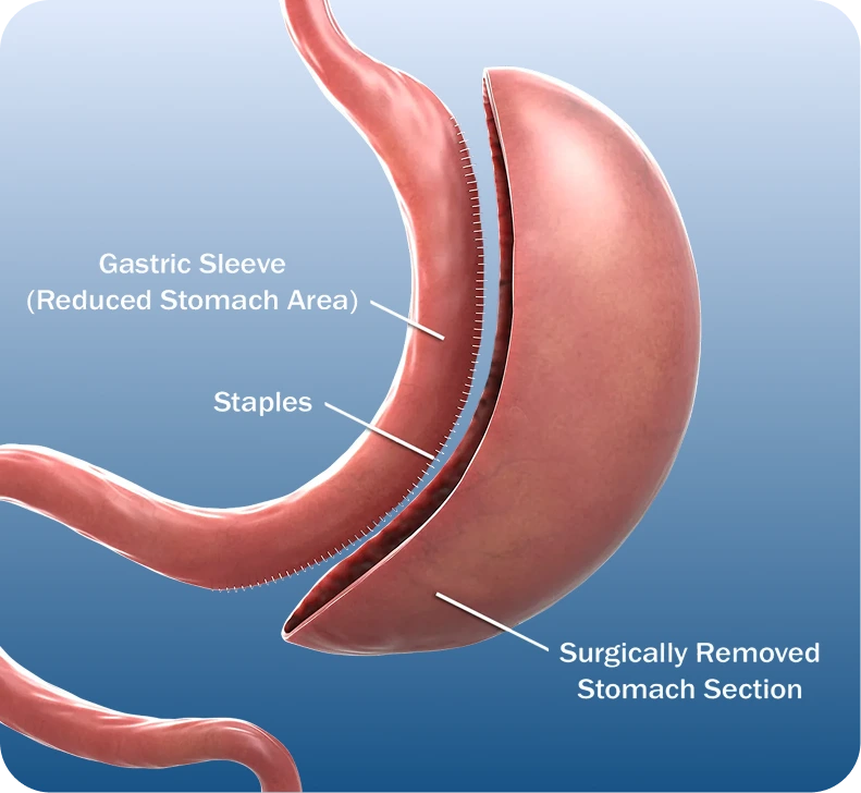 What Is Gastric Sleeve Surgery Miami, FL Banner