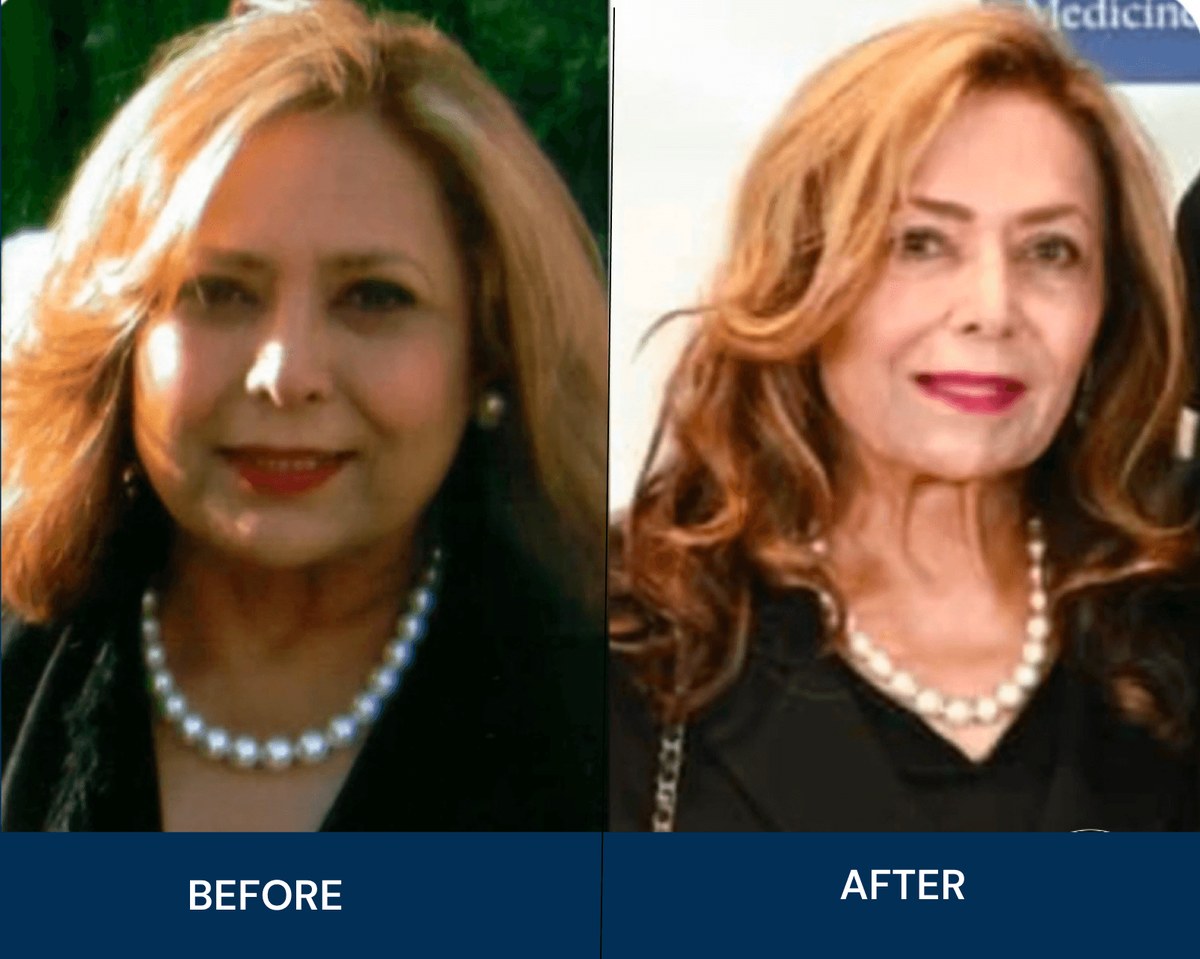 Shirley before and after weight loss surgery with Dr. Keshavarzi at Miami VIP Surgery, from 235 to 130 pounds